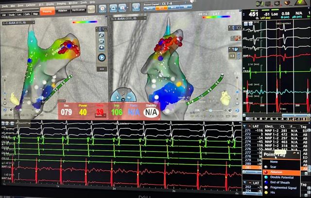 【动态】首儿所心脏内外科联手矫治儿童右心耳持续性房性心动过速