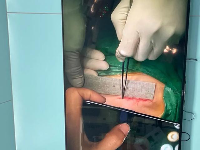 【动态】首儿所心脏内外科联手矫治儿童右心耳持续性房性心动过速