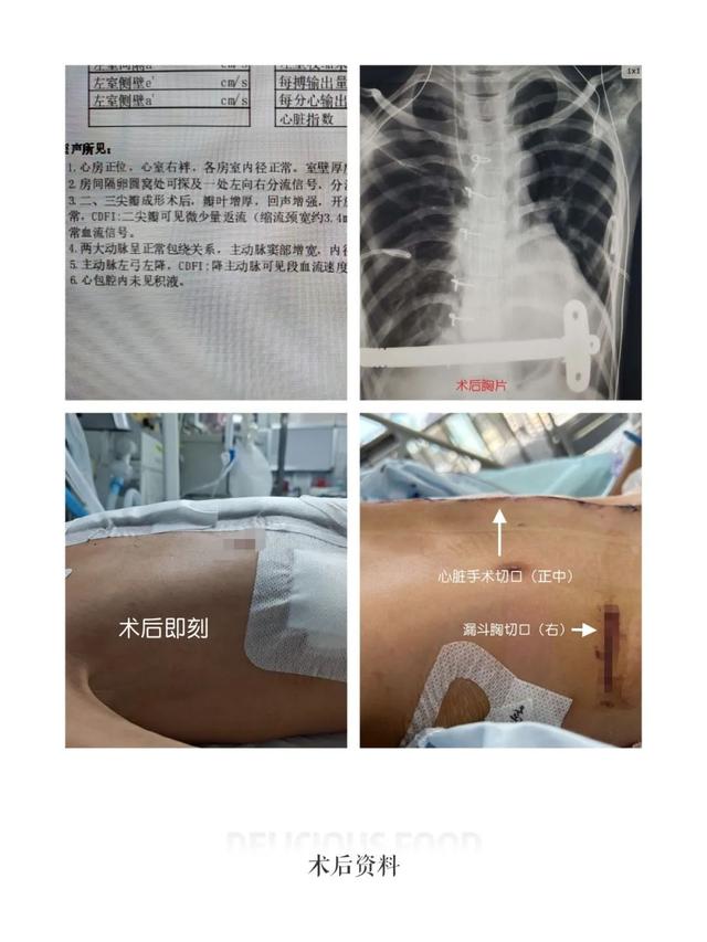 【动态】1+1＞2，首儿所多科室联合手术治疗马凡综合征患儿