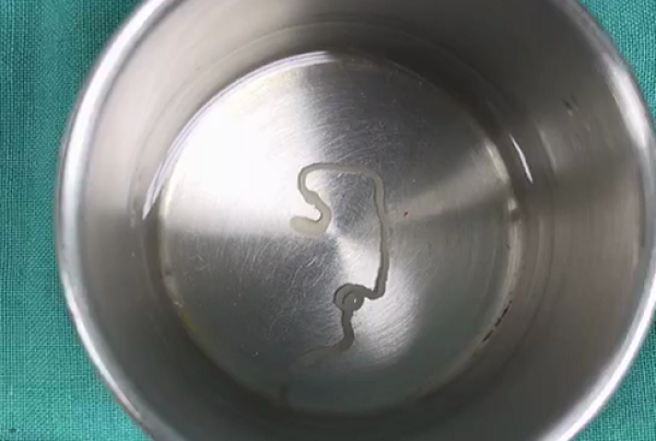 医生从患者脑部取出的寄生虫