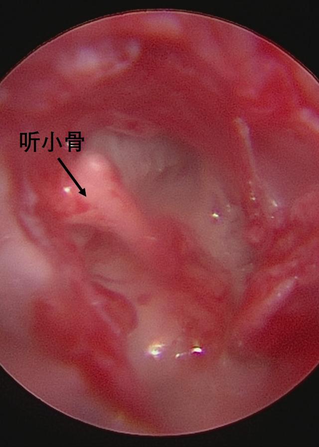 【儿研所儿医说】孩子耳朵里长出珍珠？
