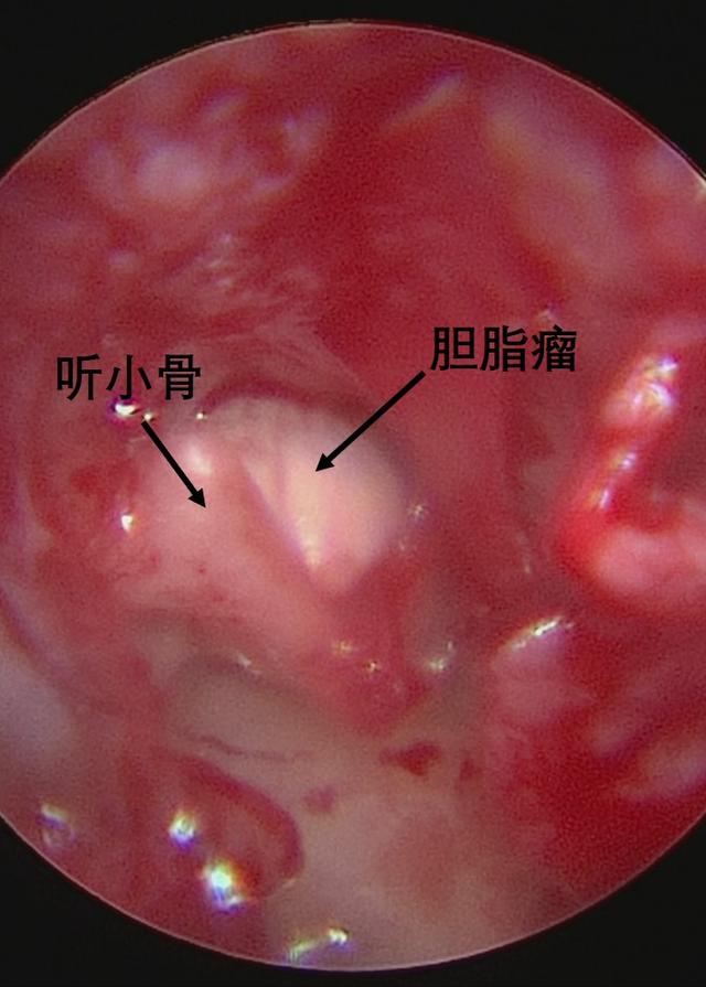 【儿研所儿医说】孩子耳朵里长出珍珠？