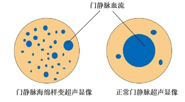 【首儿医典】门脉海绵样变