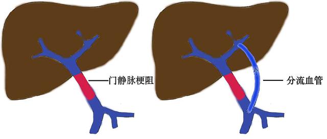 【首儿医典】门脉海绵样变