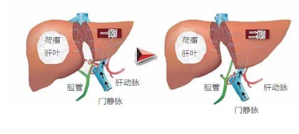 【首儿医典】肝母细胞瘤
