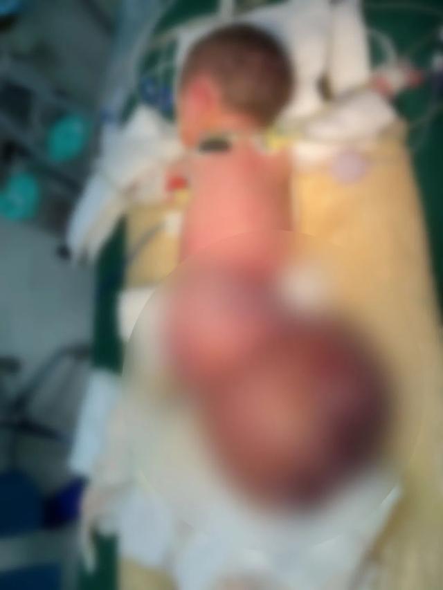 【动态】巨型骶尾部畸胎瘤患儿脱胎换骨求生记