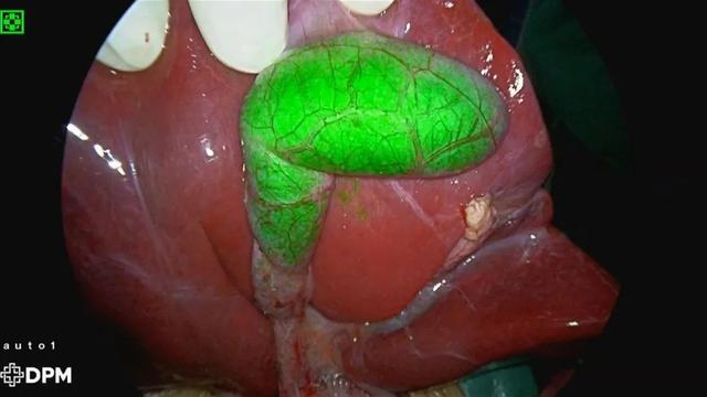 【热点】首儿所首次应用吲哚菁绿荧光导航技术，为5岁患儿切除肝母细胞瘤