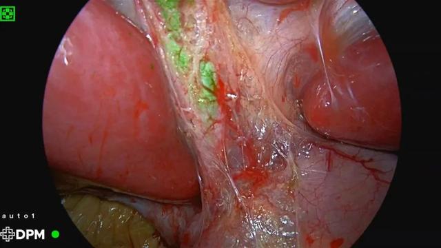 【热点】首儿所首次应用吲哚菁绿荧光导航技术，为5岁患儿切除肝母细胞瘤