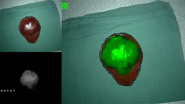 【热点】首儿所首次应用吲哚菁绿荧光导航技术，为5岁患儿切除肝母细胞瘤