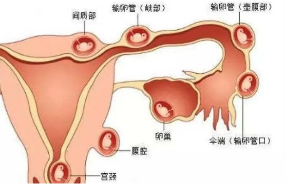 【汤医科普】宫外孕离你不远