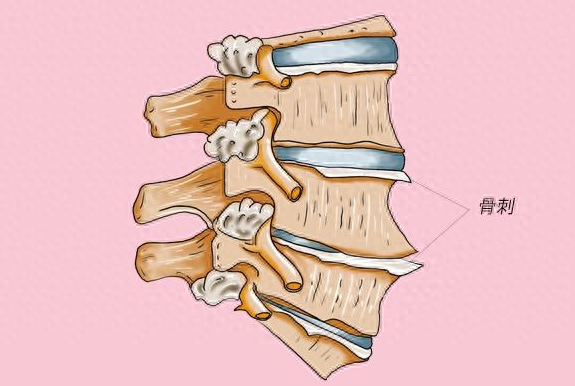 【汤医科普】骨刺是怎么回事？
