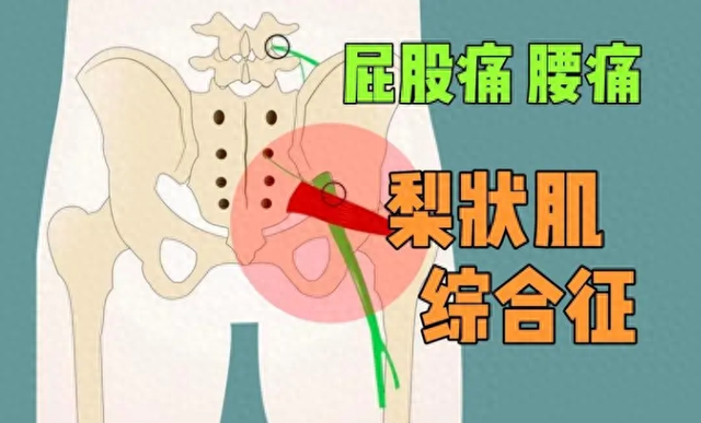 【汤医科普】一块小肌肉引发的大问题
