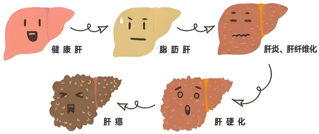 【汤医新技术】弹弹弹——肝纤维化脂肪肝无创诊断技术