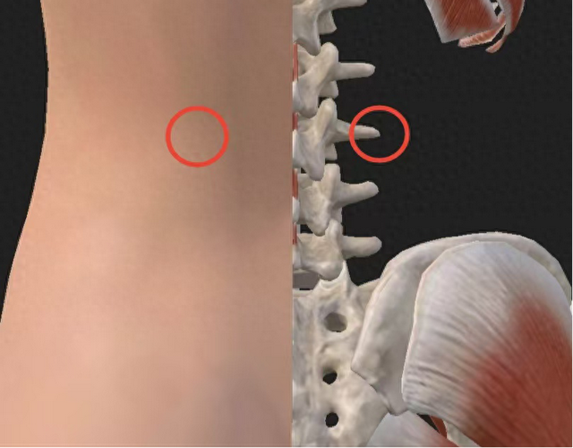 【汤医科普】慢性腰痛？劳累后反复发作？你可能得了第三腰椎横突综合征