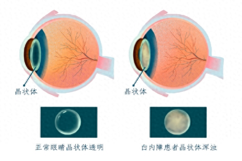 【汤医科普】白内障手术前后，这些细节千万别忽视！